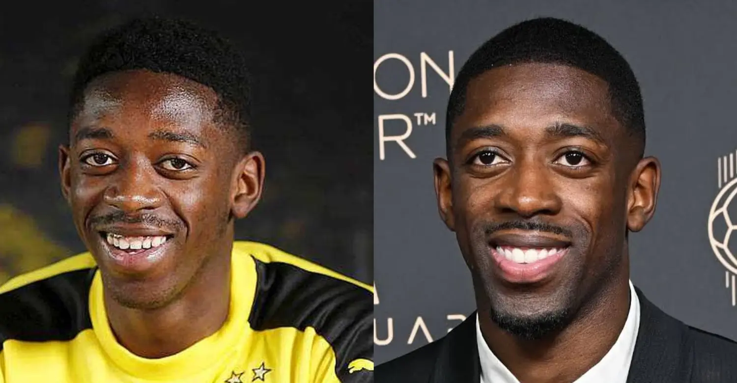 Ousmane Dembélé teeth